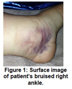 Photo of sprained ankle with extensive bruising