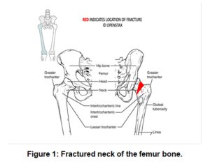 Diagram of proximal femur fracture