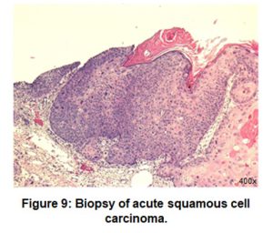 Histology of Basal Cell Carinoma